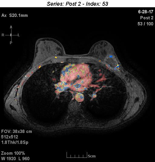 DrMichaelJPlaza's tweet photo. #Cryoablation of 5cm #breastcancer with 6 week follow up #MRI @BreastImaging @SanarusTech 

#Cryo role in #neoadjuvant or #palliative rx? https://t.co/jaXO9x8zwv