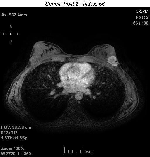 DrMichaelJPlaza's tweet photo. #Cryoablation of 5cm #breastcancer with 6 week follow up #MRI @BreastImaging @SanarusTech 

#Cryo role in #neoadjuvant or #palliative rx? https://t.co/jaXO9x8zwv