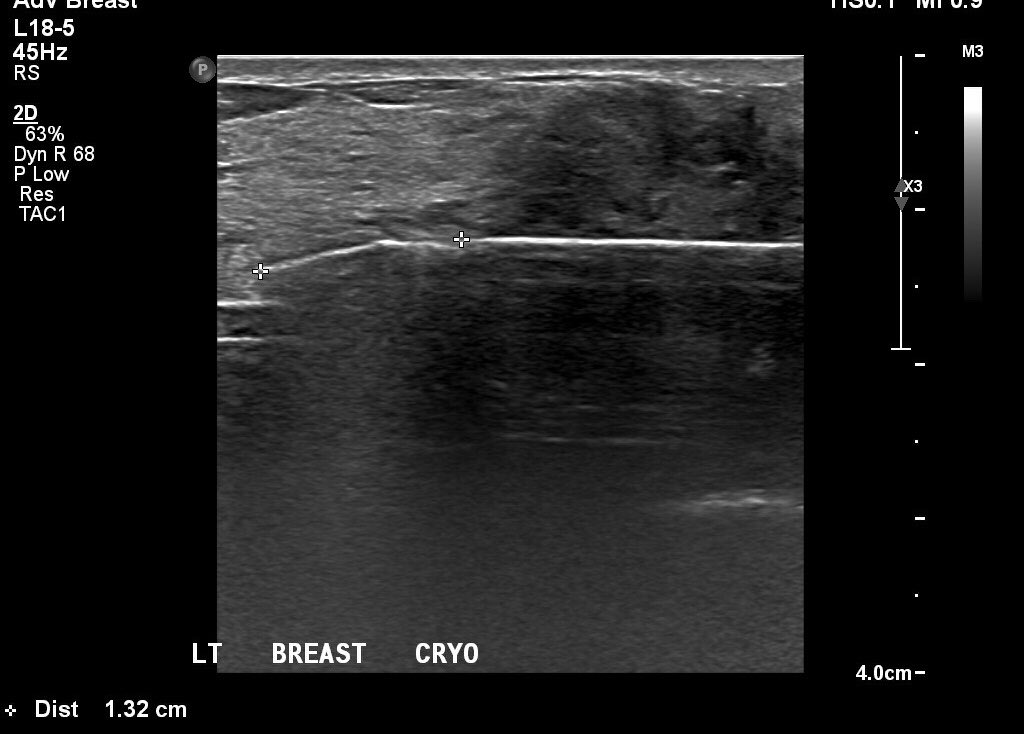 DrMichaelJPlaza's tweet photo. #Cryoablation of 5cm #breastcancer with 6 week follow up #MRI @BreastImaging @SanarusTech 

#Cryo role in #neoadjuvant or #palliative rx? https://t.co/jaXO9x8zwv
