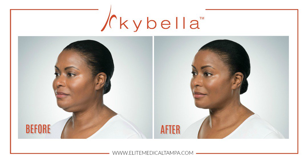 EliteMedical_FL's tweet photo. Kybella will destroy the fat cells causing you to have a “double chin”! Schedule your complimentary consultation today. 📲813.370.1045 https://t.co/Y5a829xjOi