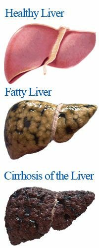 NezerCorp's tweet image. We recommend getting a regular screening of your liver!

#liver #health #getchecked