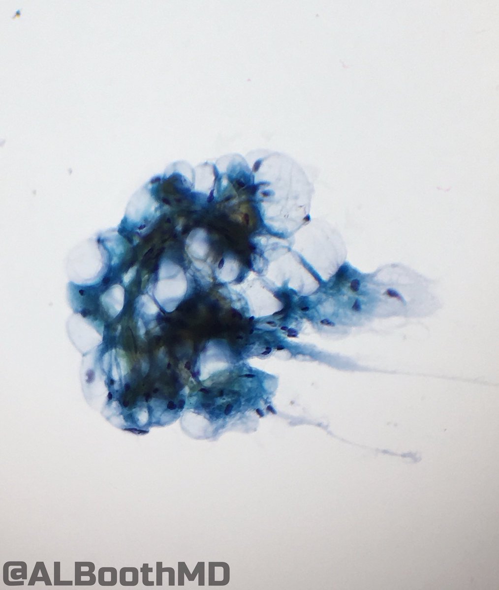 ALBoothMD's tweet photo. Jellyfish or Lipoma? #pathart #cytology https://t.co/ssPLbEtYXY