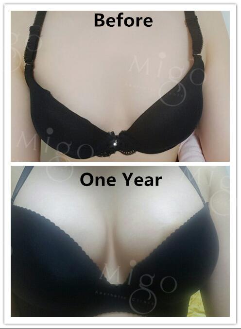 Migo Plastic Surgery on X: Breast augmentation in Migo