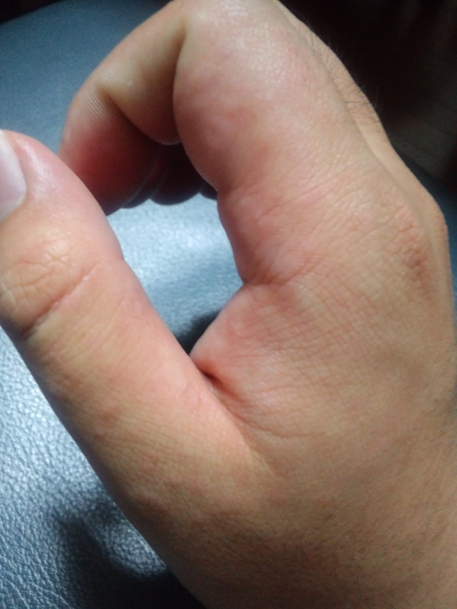 ｇ シャドウ マッ熊スク けも３id בטוויטר なんか両手と両足に赤い斑点が 若干かゆいし手の指は浮腫んじゃって 左手の人差し指だけ特にひどい 皮膚病 かぶれ ここ最近は特に虫刺されあったとかもないし 変なもの触ってもいなければアレルギー