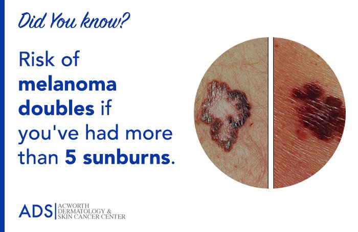 Did You Know?
Risk of #melanoma doubles if you've had more than 5 #sunburns
