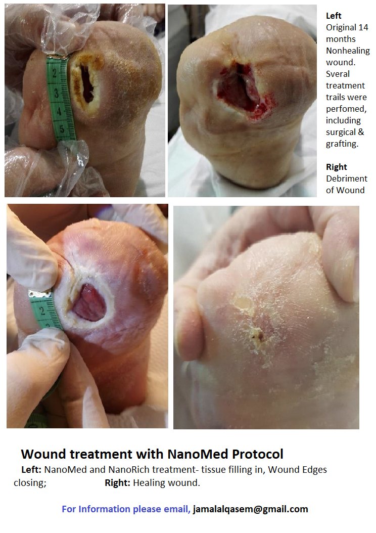 AlQasemJamal's tweet photo. #Doctors #Patients #Wound_Management #Chronic_Wounds
WARNING; Medical content تحذير.. محتوى طبي
لعلاج #الجروح و #التقرحات و #الحروق #المزمنة https://t.co/F0UjVltJ2V