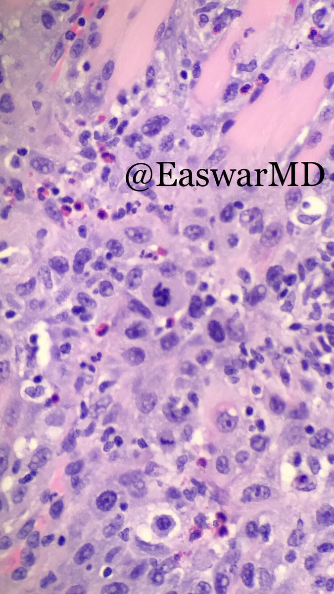 EaswarMd's tweet photo. Mitosis!!! Squiggly little thing! In the background of keratinizing squamous cell carcinoma of the tongue. https://t.co/cxPKeykKIB