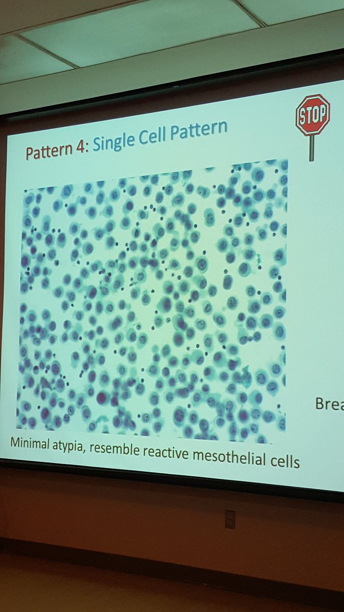 egoebs's tweet photo. Caution - single cell pattern of adenoca in a pleural effusion. Do not mistake for mesothelial cells!
#bedardsymp2017  @DrMegMcL @Path_Matt https://t.co/7faHpIQUX9