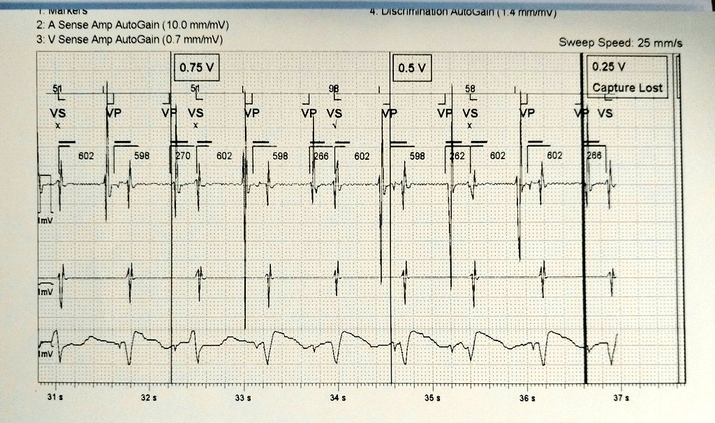 I was shown these strips and asked what is LV pacing threshold (test done at VVI 90ppm). What do you think? #PacemakerSkills