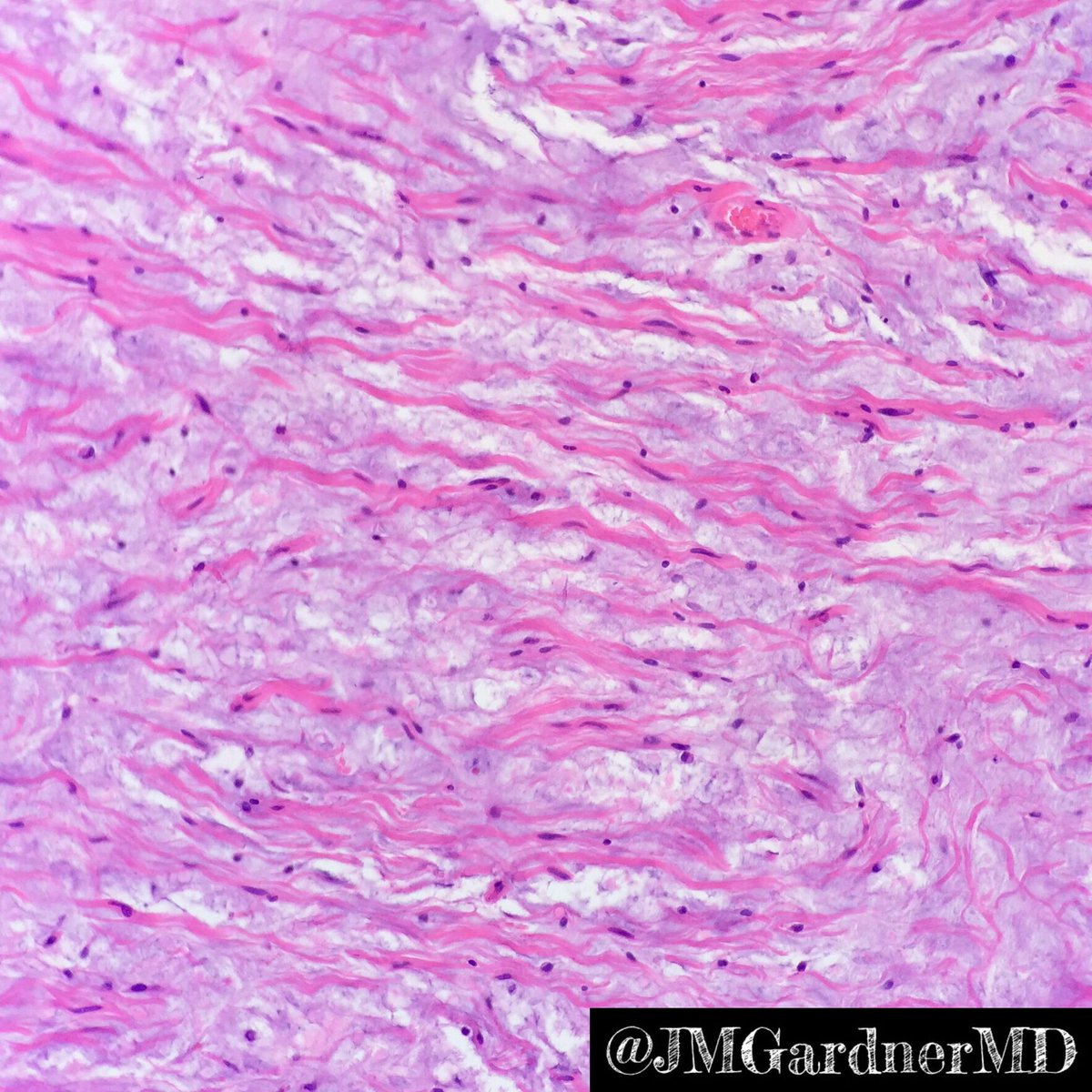 JMGardnerMD's tweet photo. Pigmented neurofibroma, plexiform &amp; diffuse. Wagner-Meissner bodies. Cells w melanin=MART1+. https://t.co/pXj3SStkXY #pathology @AJSPjournal https://t.co/sQdB9xcqxN