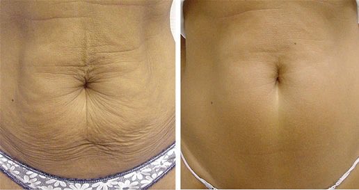 Abbyhuang606's tweet image. Amazing use of #fractionalmicroneedle #RFmachine   Check more:WhatsApp 008618691556008
Wechat: H452046984