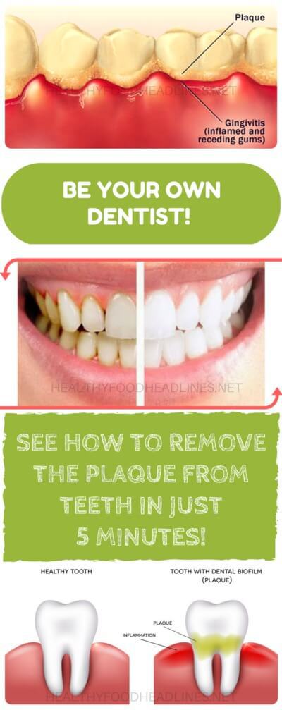 pincraftool's tweet photo. BE YOUR OWN DENTIST! SEE HOW TO REMOVE THE PLAQUE FROM TEETH IN JUST 5 MINUTES! https://t.co/A1q2XhXMmF https://t.co/bi2JonSG92