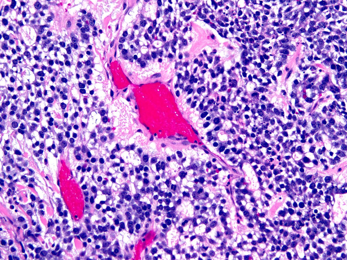 smlungpathguy's tweet photo. @dr_MPrieto @lara_pijuan What exactly is a Schiller-Duvall body? Please weigh in. Even better, quote a paper or a textbook. #pathology https://t.co/qWiJ6WQesC