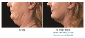 RauchWellness's tweet photo. See a #slimmer You with #Coolsculpting! Eliminate unwanted #fat without #surgery or downtime. #Boca #Delray #wellness #weightloss #treatment https://t.co/ghNnGFEHSp