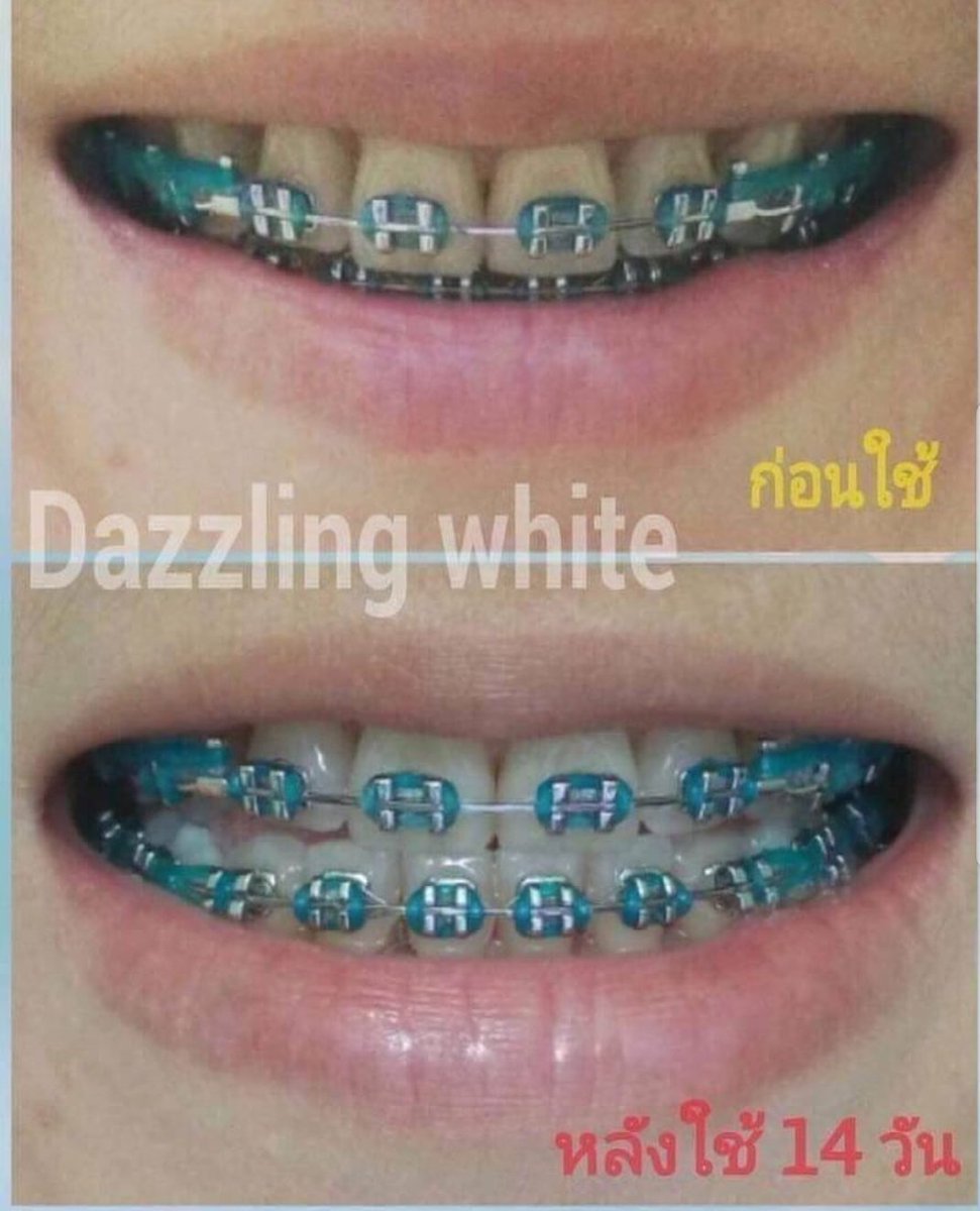Somelabblogger's tweet photo. ใครฟันเหลือง เป็นคราบ แนะนำตัวนี้เลย ดีมากตอนนี้เวลายิ้มมั่นใจขึ้นเยอะ   เรื่องจูบก็หมดห่วง 555 @Dazzlingwhite_1  #HowtoPerfect https://t.co/ZLtL63l6EC
