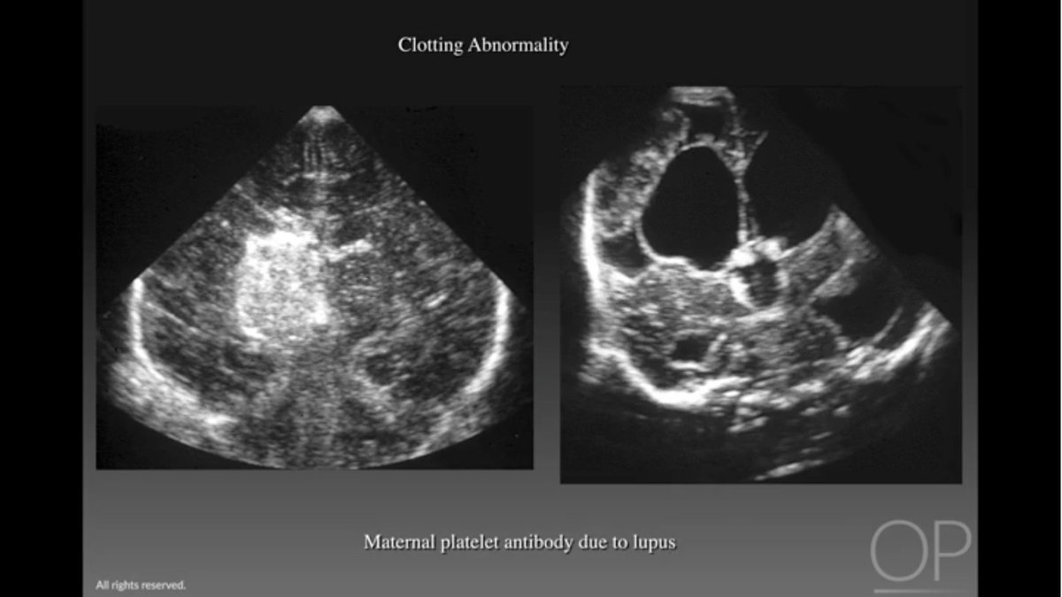 OPENPediatrics's tweet photo. Learn about #echogenic lesions in #cranial #sonography to expand the differential diagnosis of the hemorrhage https://t.co/Y5Pt5PbKXn https://t.co/mKutiqrG6Y