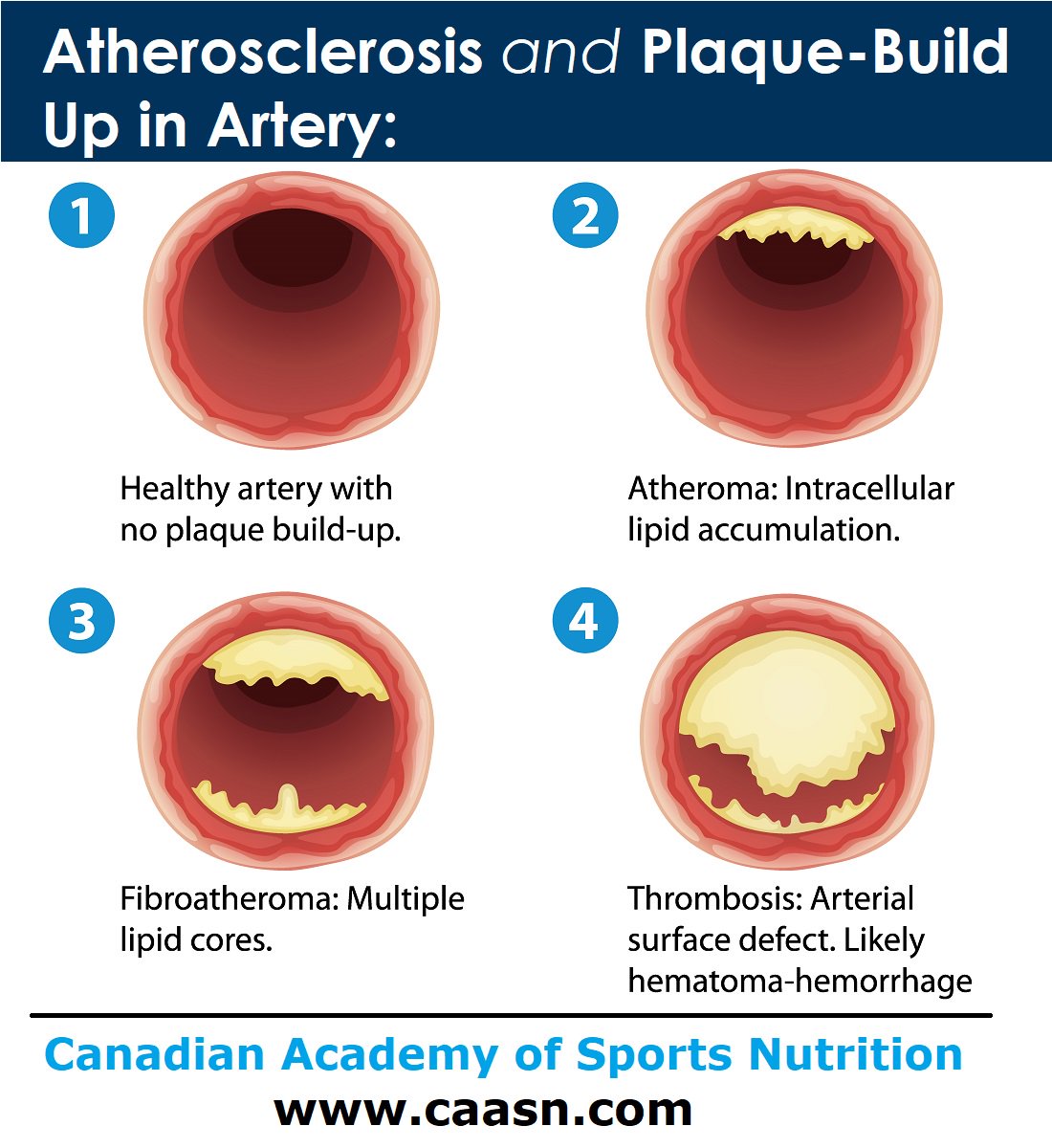 caasn2015's tweet photo. #Atherosclerosis #PlaqueBuildUp
#ArteryOcclusion #heartattack https://t.co/b2AXzd0lRo