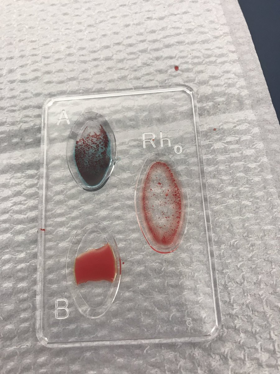 h_moh21's tweet photo. Found out my blood type in last weeks lab! A positive!! @NutmegSomething #Bio110Fall17 https://t.co/GTOCfFFiOd