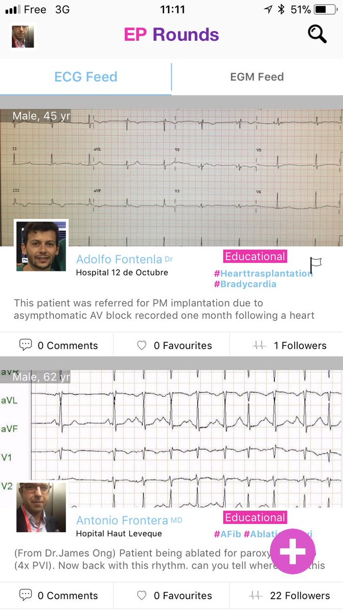 sozi81's tweet photo. @drrakeshg1 and @ECGTalk what would you do? Patient referred for PM implant after asympt AV block fewdays after Heart traspl. now #Eprounds https://t.co/9NJFrymRio