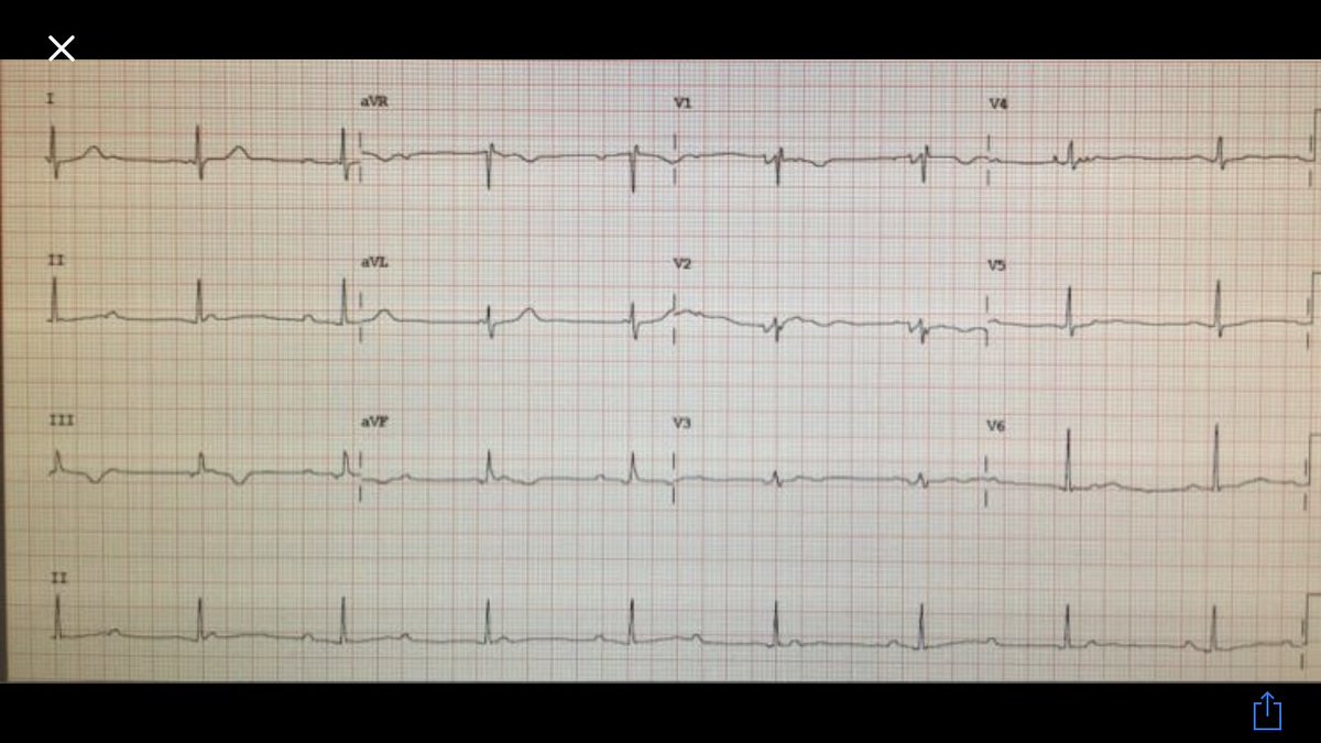 sozi81's tweet photo. @drrakeshg1 and @ECGTalk what would you do? Patient referred for PM implant after asympt AV block fewdays after Heart traspl. now #Eprounds https://t.co/9NJFrymRio