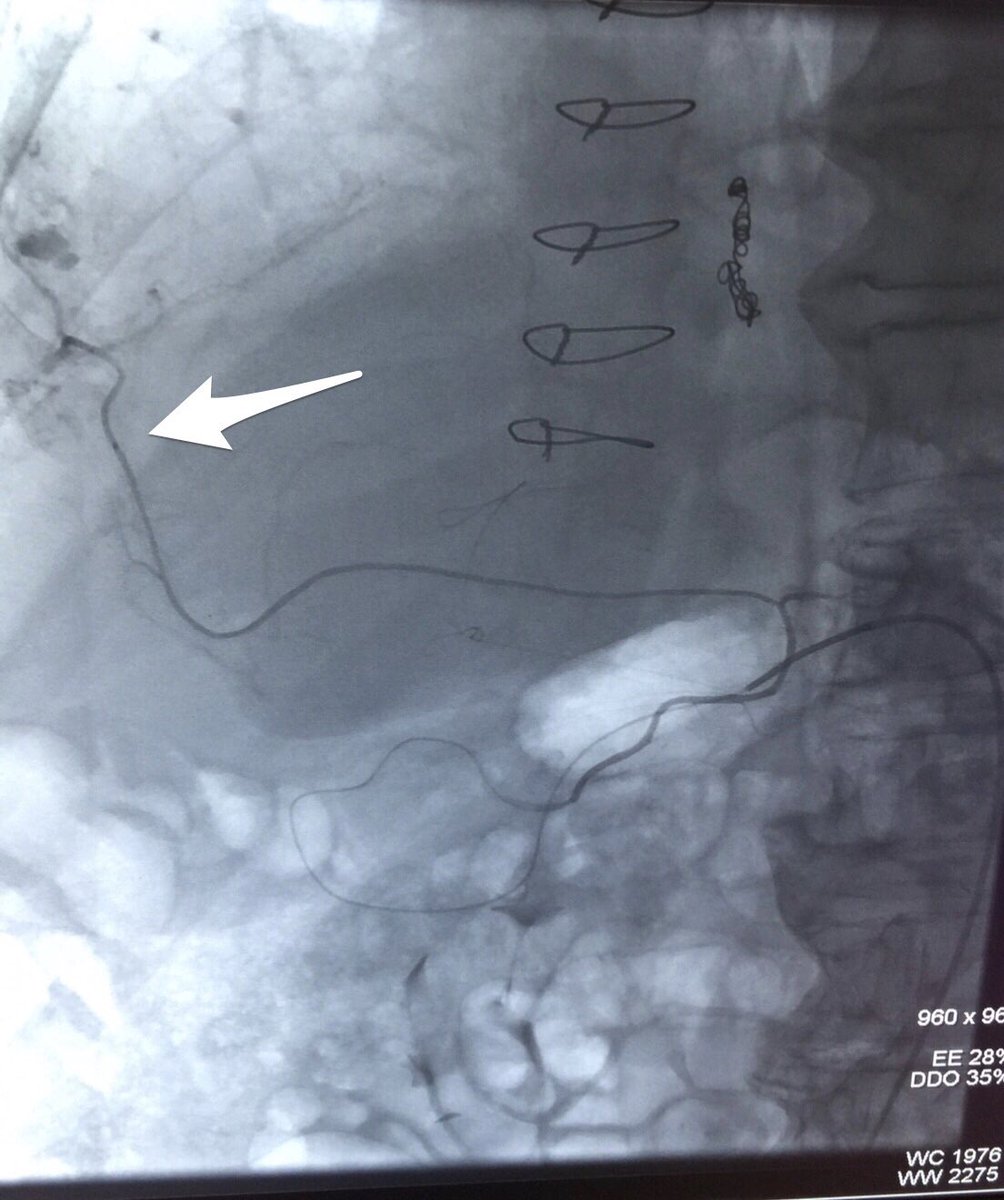medravi's tweet photo. Parasitized omental artery feeding an HCC #killcancer #hubbed #irad @medravi @CHICKVIR @JVIRmedia @CVIR_Journal @SIRspecialists @SIRRFS https://t.co/Ci2syayJUC