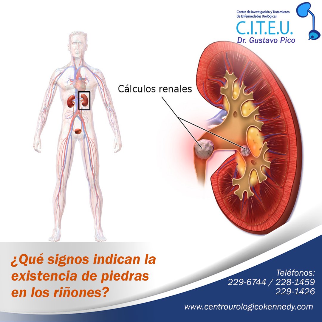 citeu_ec's tweet photo. ¿Qué signos indican la existencia de piedras en los riñones? https://t.co/nRstthSiXR https://t.co/tTsl7MjzsH