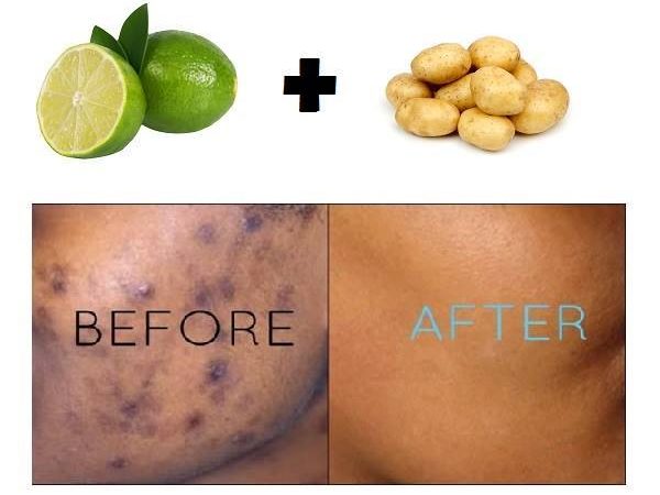 healthbytez's tweet photo. 5 minutes remedy to remove all black spots from your skin https://t.co/FTEdC8tLWe #Skin #skinfood #skincare #beautiful #beauty #beautytips https://t.co/kGuAOS0r06