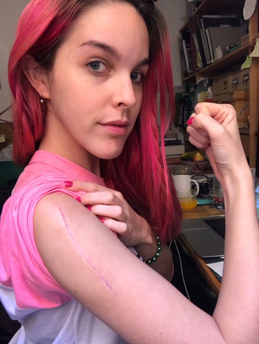 Not a scar, but a trophy won in a battle 💪 https://t.co/g64jjW7Ec2<a href="/tag/tbt"class="tags"><span>#tbt</span></a>