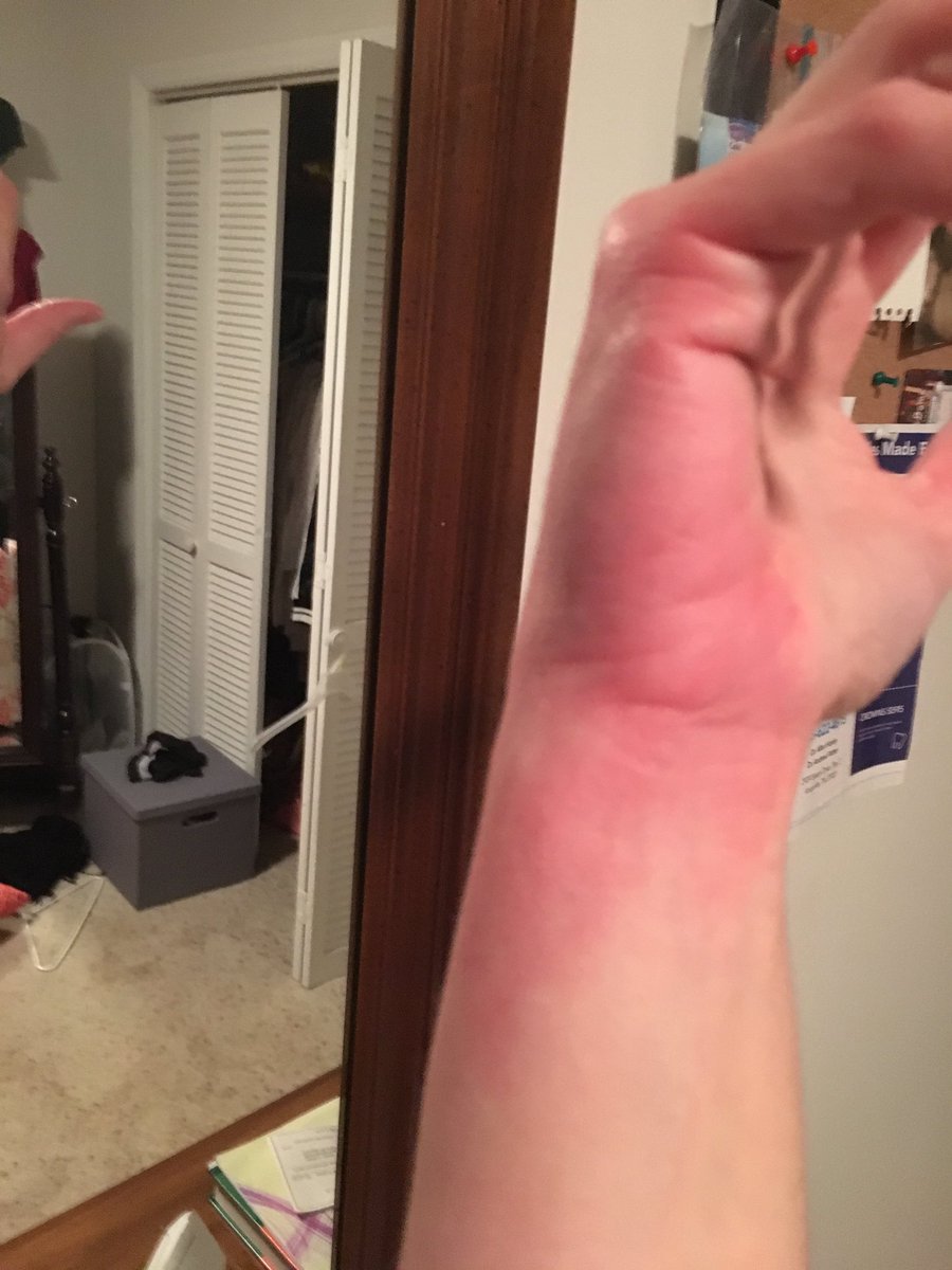 PaigeGildner's tweet photo. Spider bite = numbness &amp; contracted fingers. Definitely have a new appreciation for limited use of your dominant hand. #OccupationalTherapy https://t.co/k4oNoP9o0z
