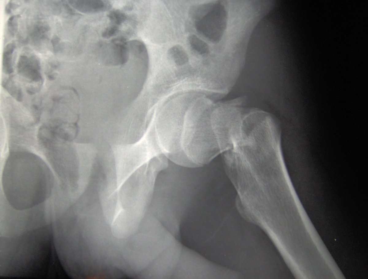 RandyClarkMD's tweet photo. Multiple risk factors, BMD associated with hip fracture in older men. #hipfracture
- https://t.co/wqpp1ZPeC3 https://t.co/kf222fdidr
