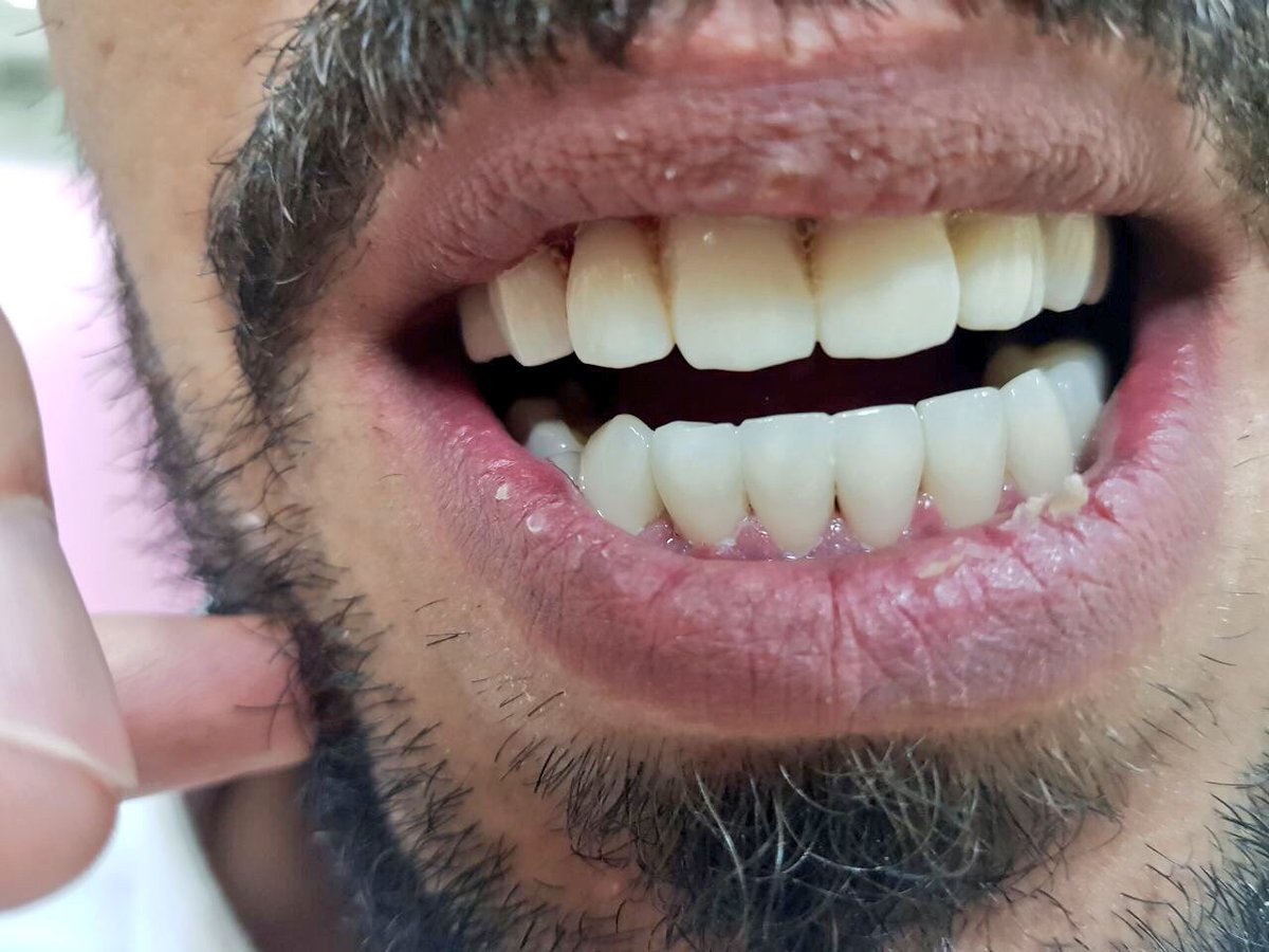 حالة #فينير صعبة جداً #عيادات #اسنان #تجميل_الاسنان #ابتسامة_المشاهير #رئعة #