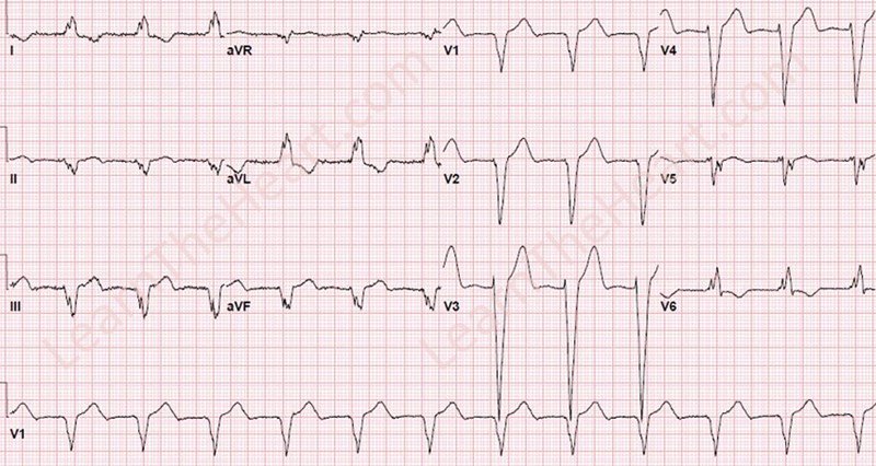 ECGQuizzes's tweet photo. ECG Quiz Daily

58 yo with chest pain

https://t.co/E34bvlYfr0

#ECG #USMLE #Cardiology https://t.co/LGlPIHlRxc