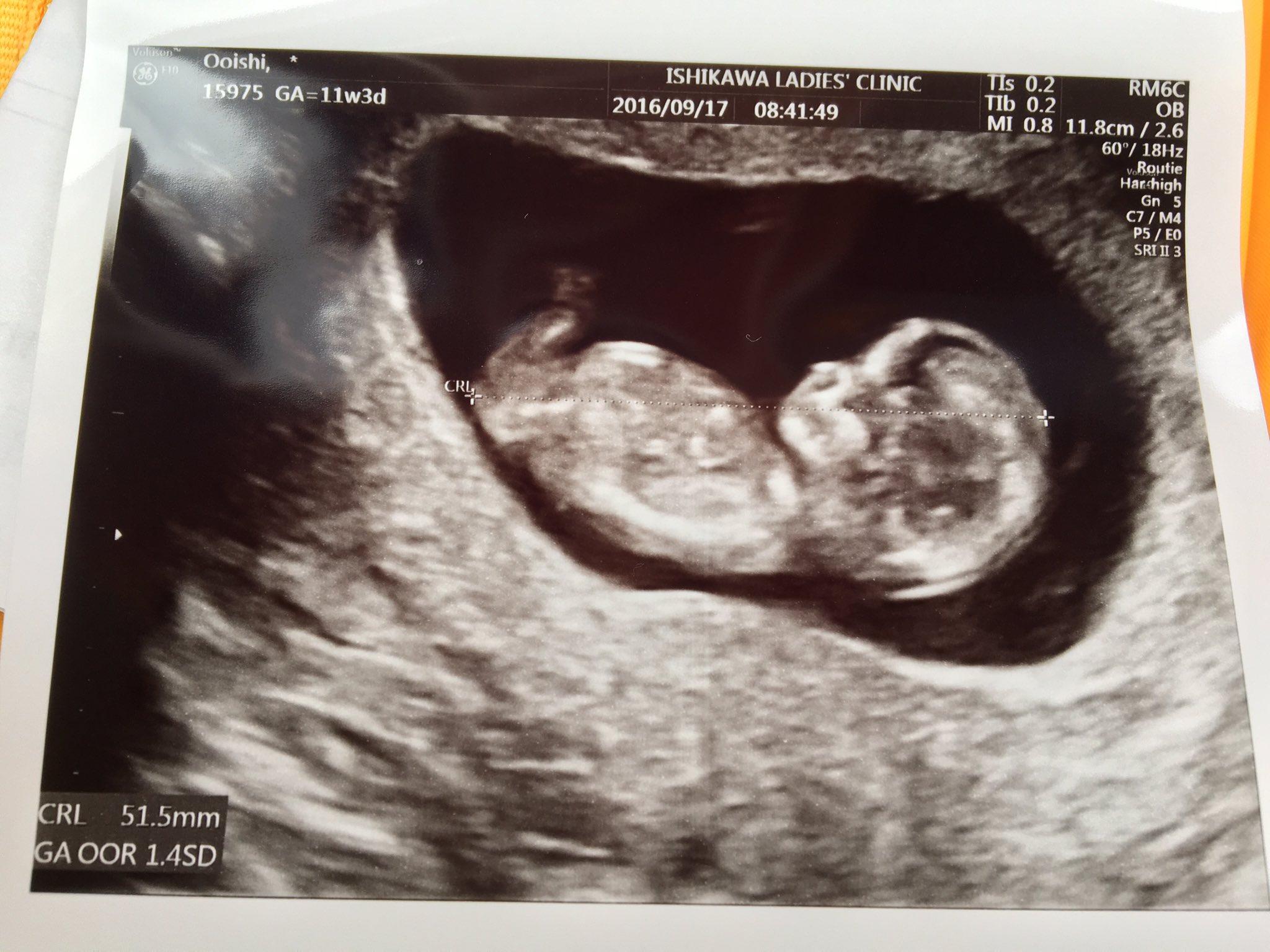 ツナぱんだ なんだ 妊娠成立後 2回目の受診 お腹の子は すくすく成長してくれていた ありがとう 妊娠 11週頃にもらったこのエコー写真は宝物 妊娠 エコー T Co Trmjxpo0lv Twitter