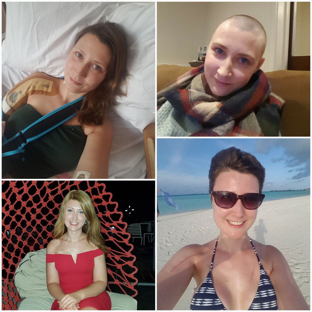 #Stage4breastcancer reality Doublemastectomy & recon,metal shoulder.12chemo, 3weekly treatment keeping me alive
#InvisiblyDisabledLooksLike