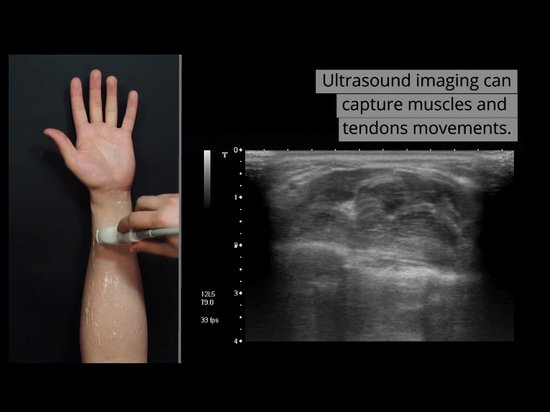 MedicalExpoNews's tweet photo. Future smartwatches could sense hand movement using ultrasound imaging https://t.co/ac7neNwgjY https://t.co/YrjQGOHg27