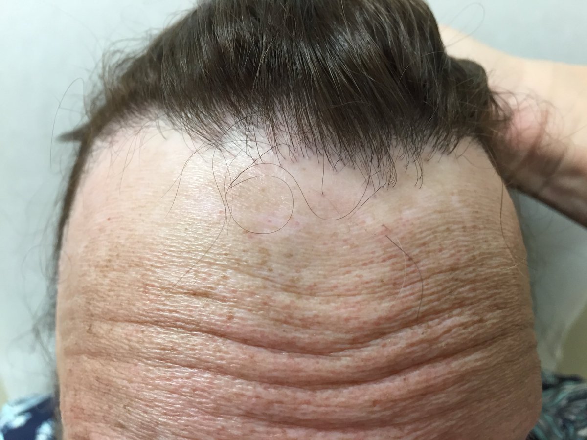 LenSperling's tweet image. Typical Image of frontal fibrosing alopecia. A few lonely hairs can be seen near the border of the receding hairline #dermpath #asdp2017