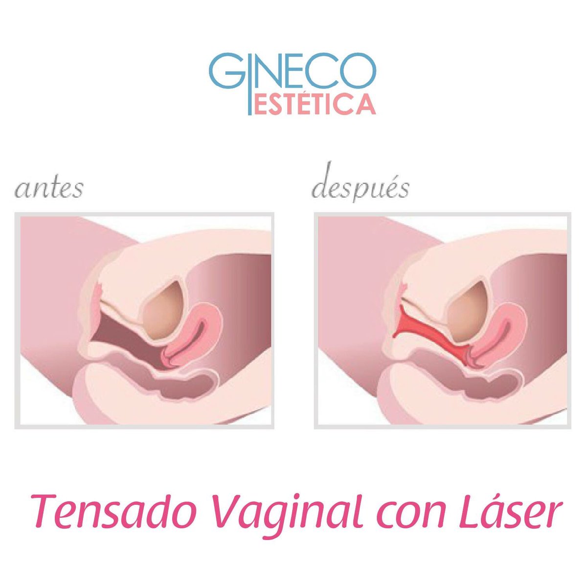 dermacarespa's tweet photo. #tensadovaginal contribuye al aumento del diámetro vaginal. que utiliza el efecto térmico de la luz láser fotona aumentando el colágeno. https://t.co/8xg0yVtO2C