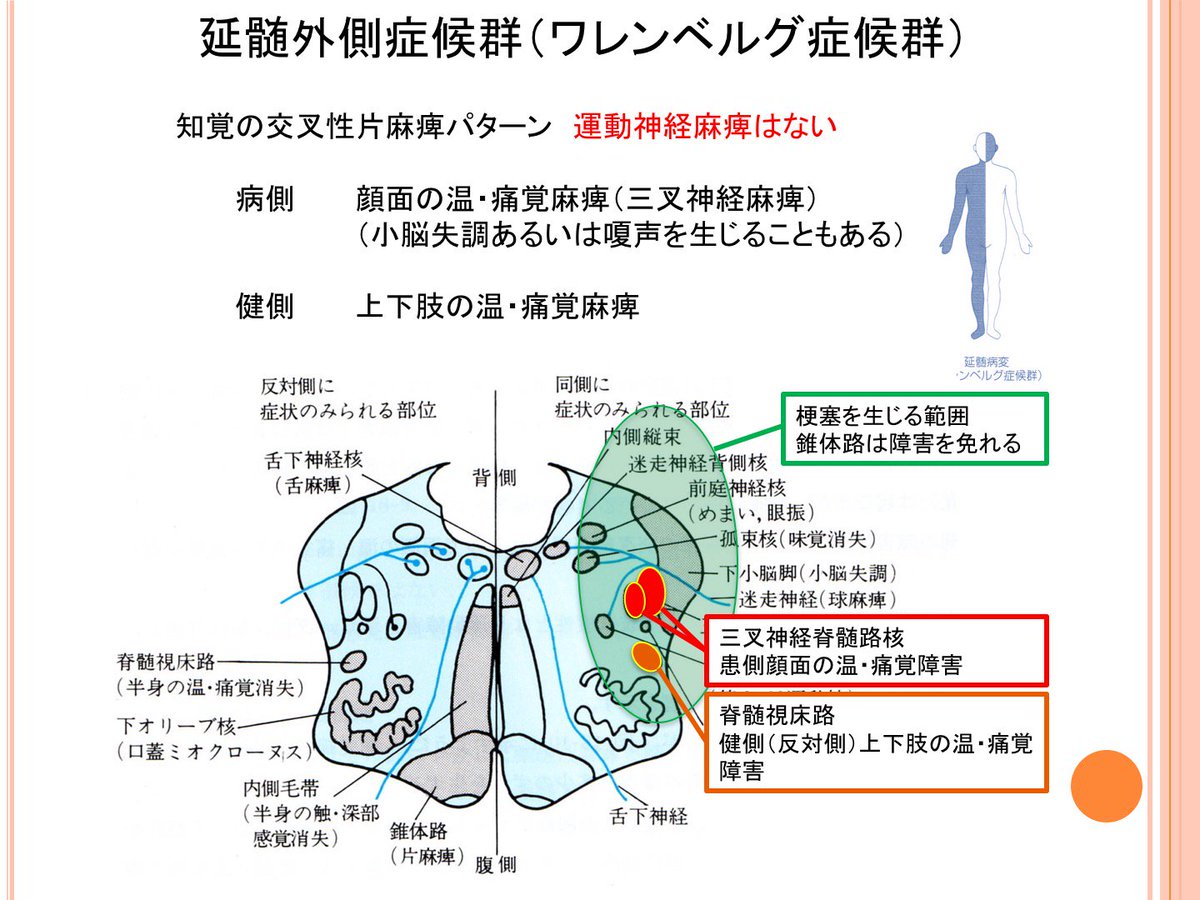 延髄 外側 症候群 Article