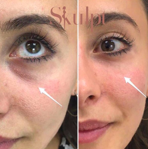 Fantastic results from tear trough filler carried out by Dr. Diwan. If you would like to book, please call Skulpt on 01565745680