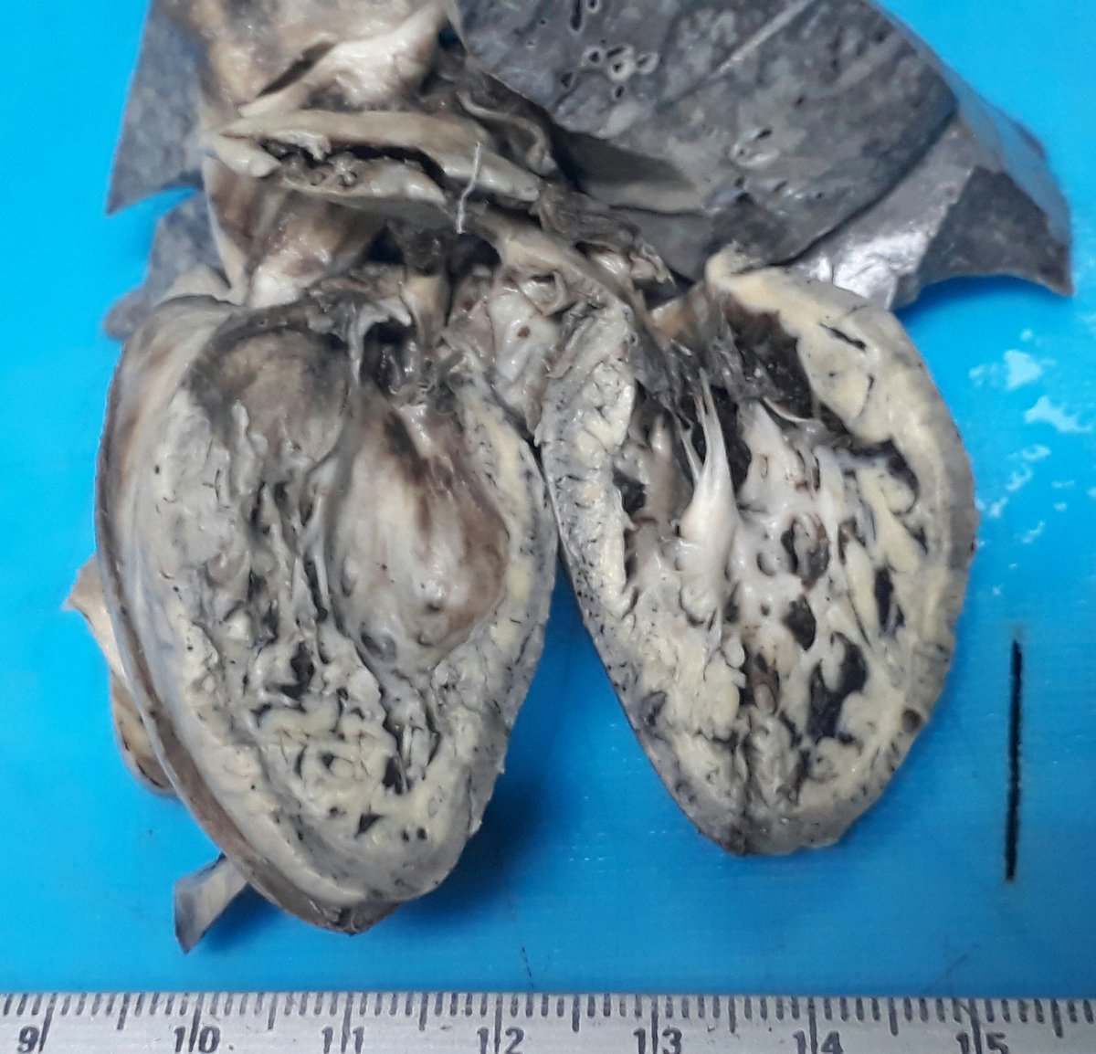 Left ventricular non compaction cardiomyopathy.
