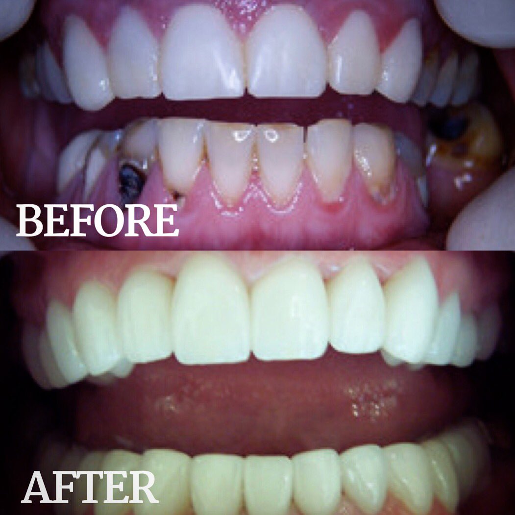 team_krohdental's tweet image. More work done to fix people’s smiles at team kroh! 
¡Más trabajo hecho para arreglar las sonrisas en team kroh 
 #fixyoursmile