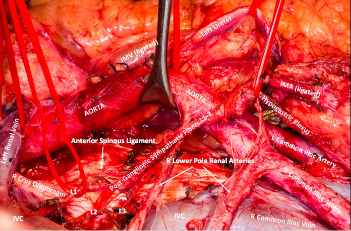 Arun Z. Thomas (@arunzthomas) on Twitter photo Post-chemotherapy full template nerve sparing RPLND for metastatic #TestisCancer in #TallaghtHospital w/ <a href="/boltyeva/">Eva Bolton</a> and <a href="/Sgnanam22/">Sanjith Gnanappiragasam</a> Post-chemotherapy full template nerve sparing RPLND for metastatic #TestisCancer in #TallaghtHospital w/ <a href="/boltyeva/">Eva Bolton</a> and <a href="/Sgnanam22/">Sanjith Gnanappiragasam</a>
