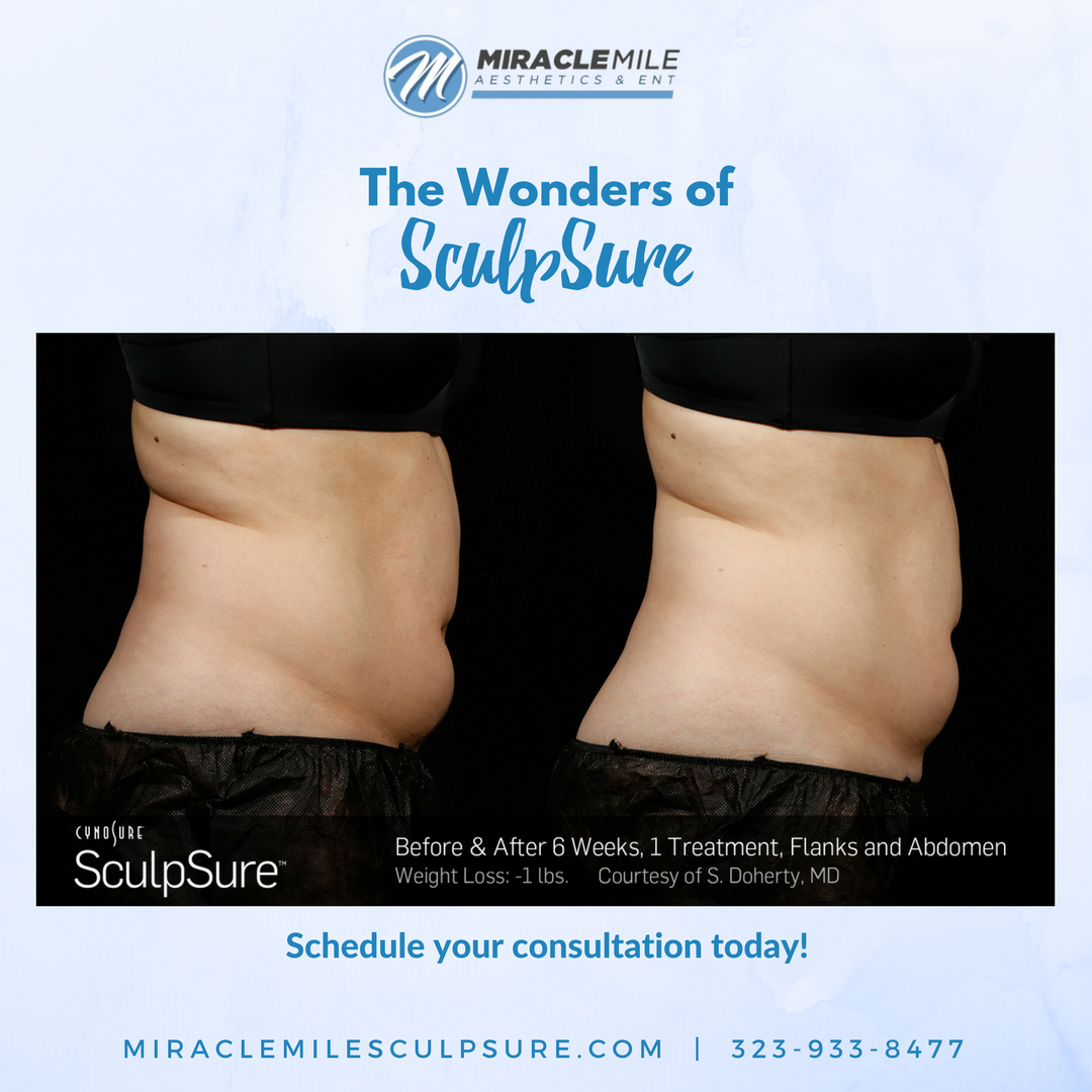 miraclemilemd's tweet photo. SculpSure is the next generation in non-surgical fat reduction--see results in just 6-12 weeks! Amazing!  #sculpsure #transformation https://t.co/Hkbvst91Rr