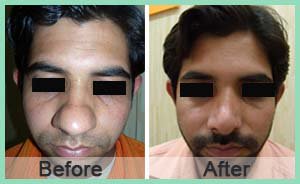 bilalfazal's tweet photo. #Rhinoplasty, commonly known as a #nose_job, is a #plastic_surgery procedure for correcting and aesthetically enhancing the nose. https://t.co/7KW4OndOcD