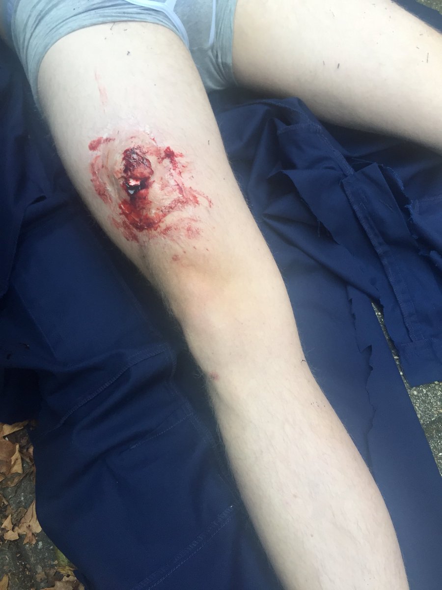 ShadmanAziz2's tweet photo. Early exposure of wounds is key! Donโt be afraid to cut off clothes! #ERConf17 #exposure #tuffcuts https://t.co/Xuu71Rceu2