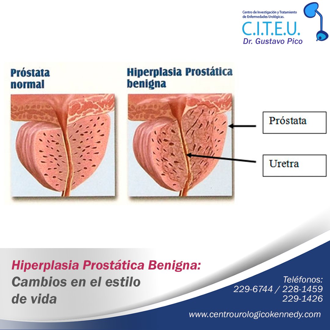 citeu_ec's tweet photo. Hiperplasia Prostática Benigna: Cambios en el estilo de vida. https://t.co/NHsxatOr5n https://t.co/HWAdKUNRof