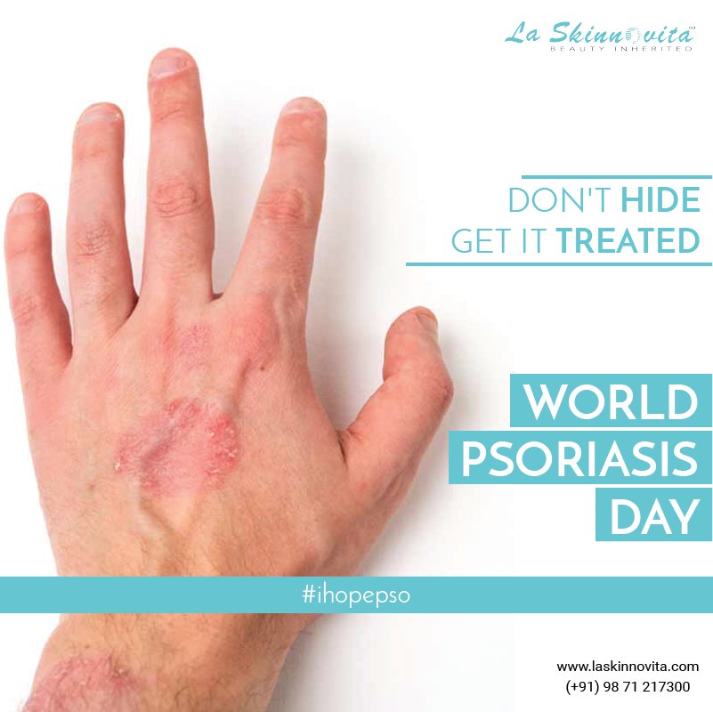 LaSkinnovita's tweet photo. Don't hide.
Get it treated.
World Psoriasis Day
#ihopepso https://t.co/Ykm8YdEfwg