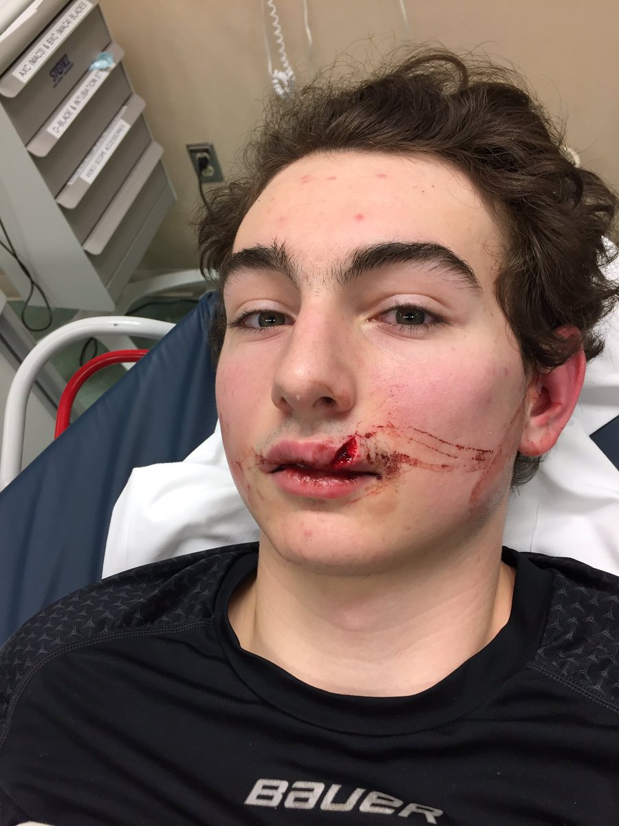 Muskies_Hockey's tweet photo. @Muskies_Hockey On way 2 hospital to get this beauty after a nasty high 🏒 Boys rallied for 4 Gino's 🚨in 3rd to sweep @Hudson_Havoc #USPHL https://t.co/TYdHp7IiCC