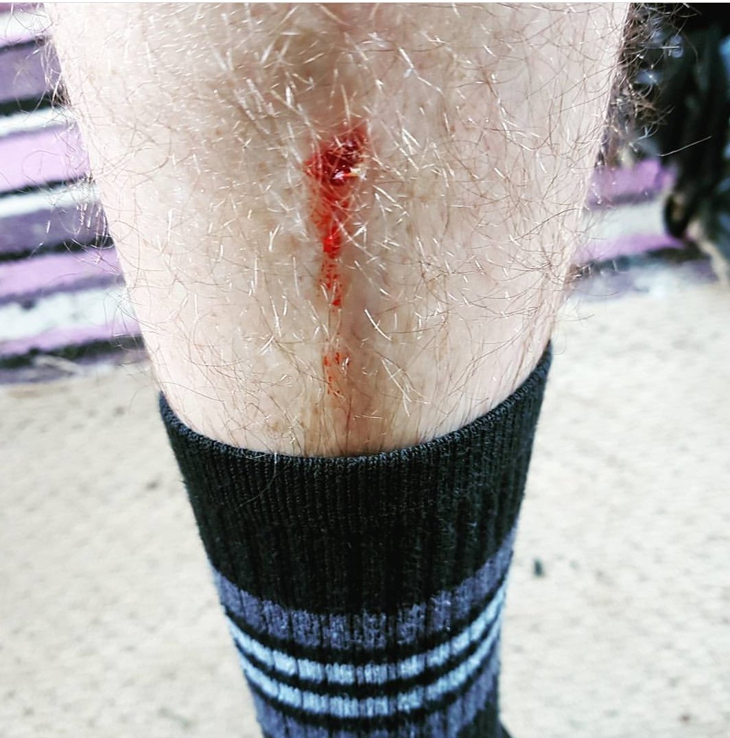 Dadstrength1's tweet photo. Deadlift lovebite https://t.co/m5W1IPi3zN