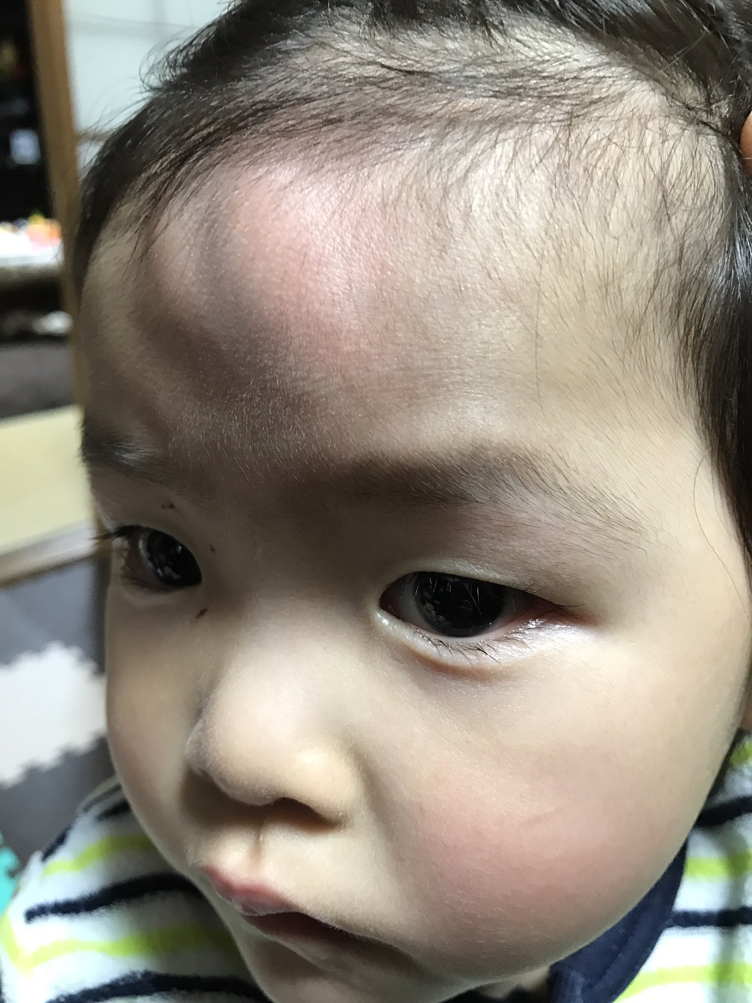 Mimimi やばいたんこぶできた みんなこれどうしよん 病院行くべき 今は眠かったんか寝よる Mimimi やばいたんこぶできた みんなこれどうしよん 病院行くべき 今は眠かったんか寝よる